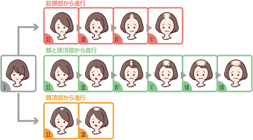 ・前頭部から進行 ・額と頭頂部から進行 ・頭頂部から進行